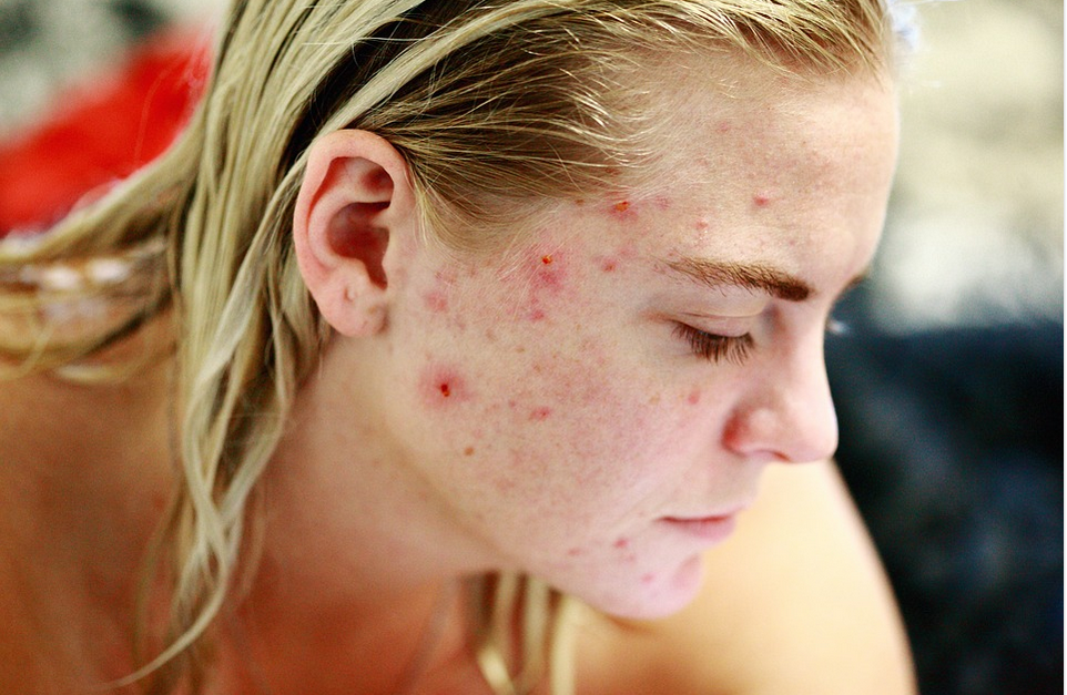 a lady suffering from acne